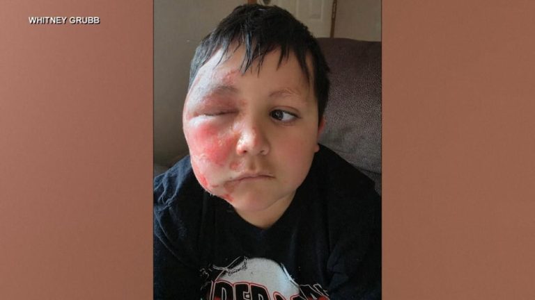 WATCH:  Mom shares warning after son is severely burned following social media trend