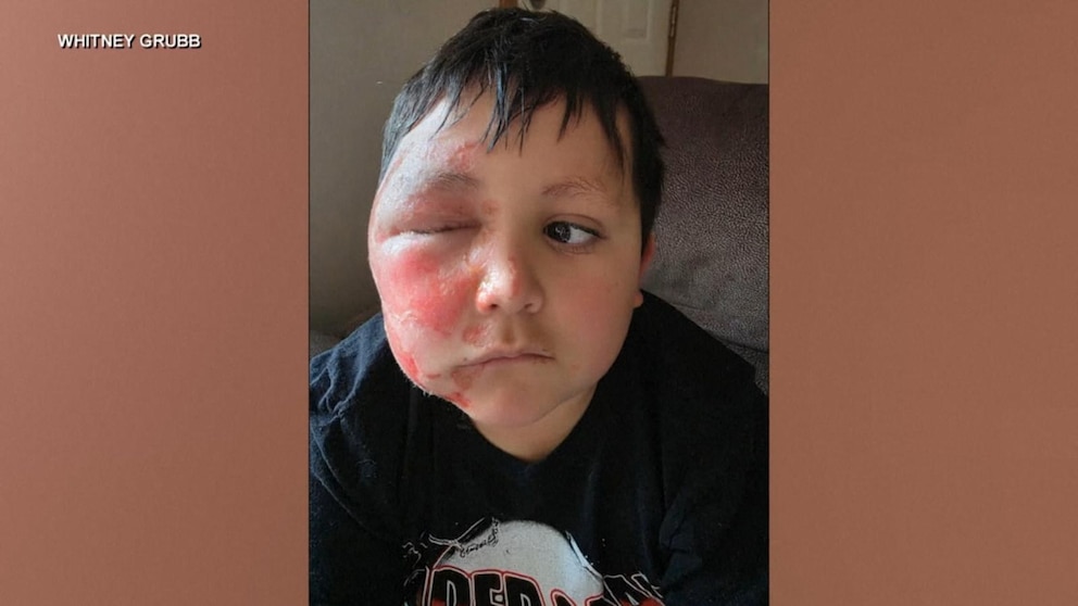 WATCH: Mom shares warning after son is severely burned following social media trend